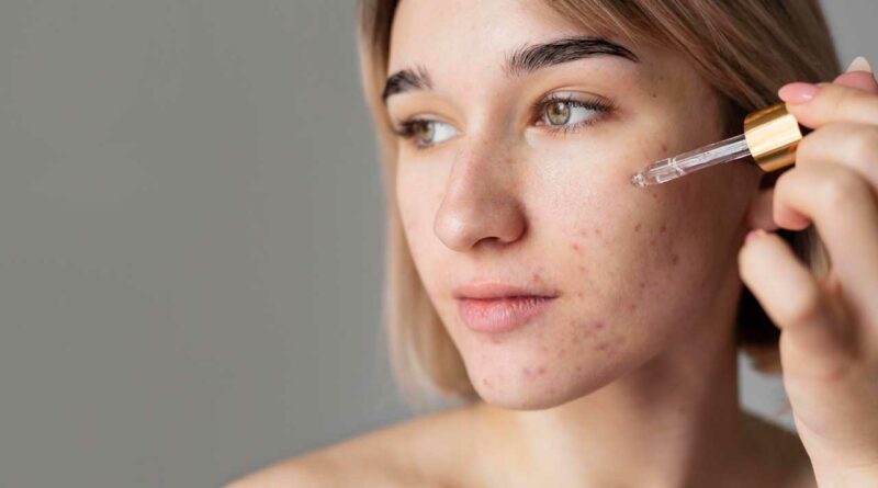 Elimina las manchas y cicatrices del acné: Consejos y Productos
