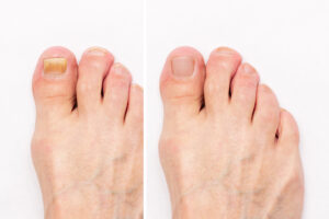 onicomicosis: como prevenir los hongos de los pies