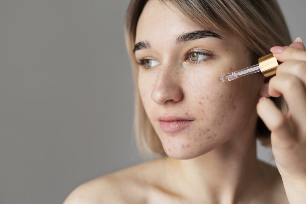 acné facial