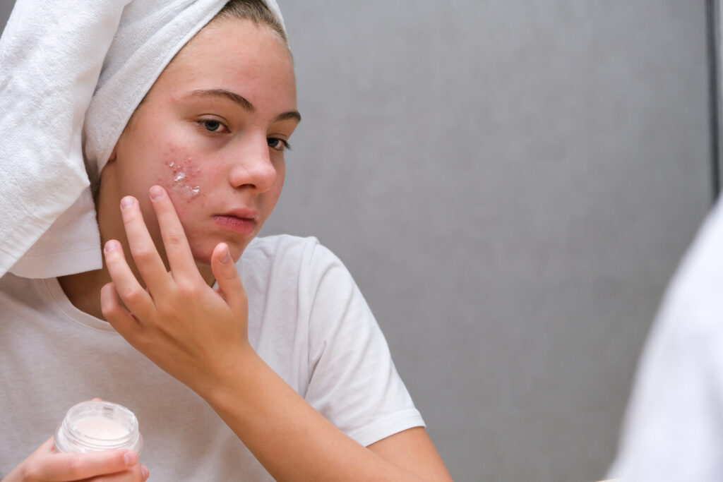 Acné facial