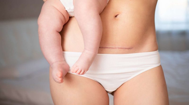 cicatriz de cesarea en mamá con color acentuado, que necesita cuidado y tratamiento